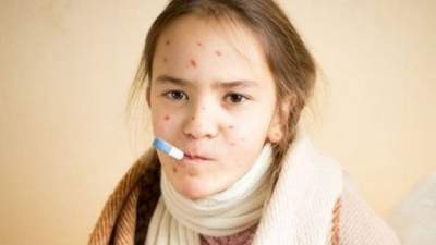 В Киеве участились случаи заболевания корью