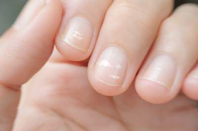 Медики объяснили, из-за чего могут появиться белые пятна на ногтях