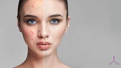 Диетологи назвали продукты, помогающие очистить кожу лица
