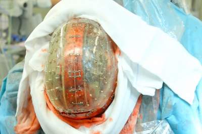 В Израиле появился первый мужчина с пластиковым протезом черепа